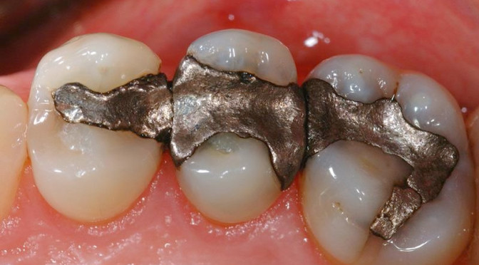 mecuy fillings